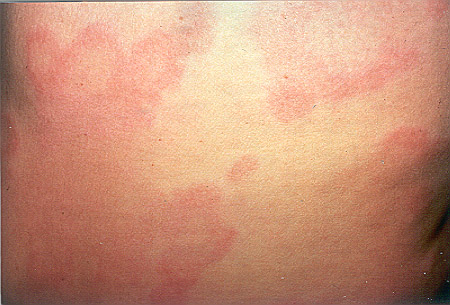 pictures of hives rash poison oak sumac