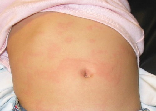Robaxin Rash