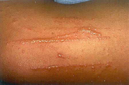 spider bite rash pictures. Poison Ivy Rash on Forearm