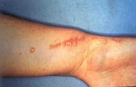 poison oak rash pictures. Poison Ivy Rash on Wrist