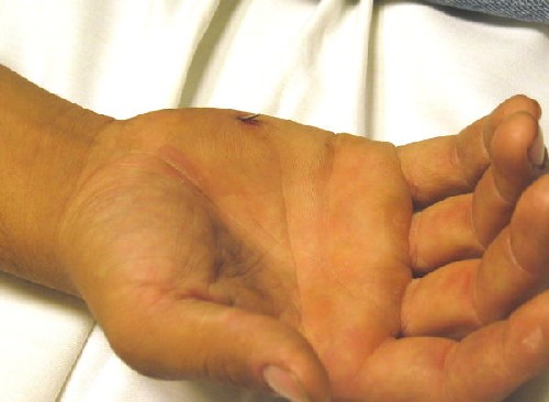 Care Advice For Puncture Wound