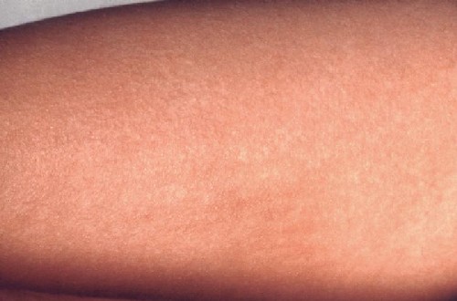 spider bite rash pictures. Scarlet Fever Rash