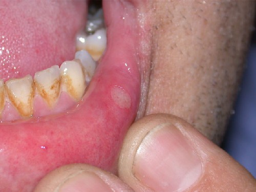 Lip Sore - Symptoms, Causes, Treatments - Healthgrades.com